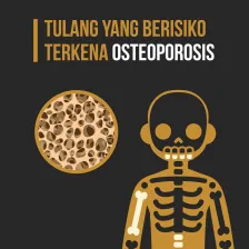 Tulang Yang Berisiko Terkena Osteoporosis