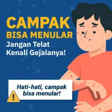 Campak Bisa Menular, Jangan Telat Kenali Gejalanya!